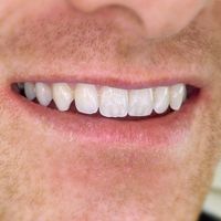 Composite Bonding - Smile 17 before